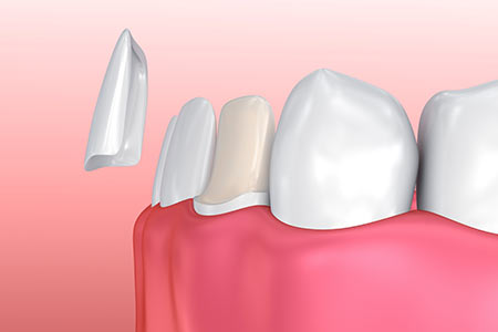 Porcelain Veneers